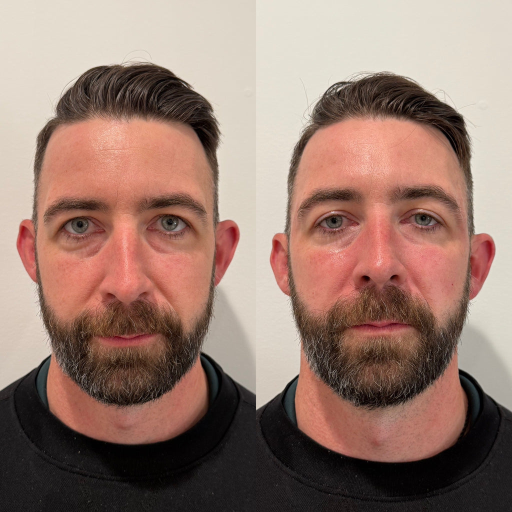 LUV U: Mini Luxe. Lift Package + FREE 20 Units Botox