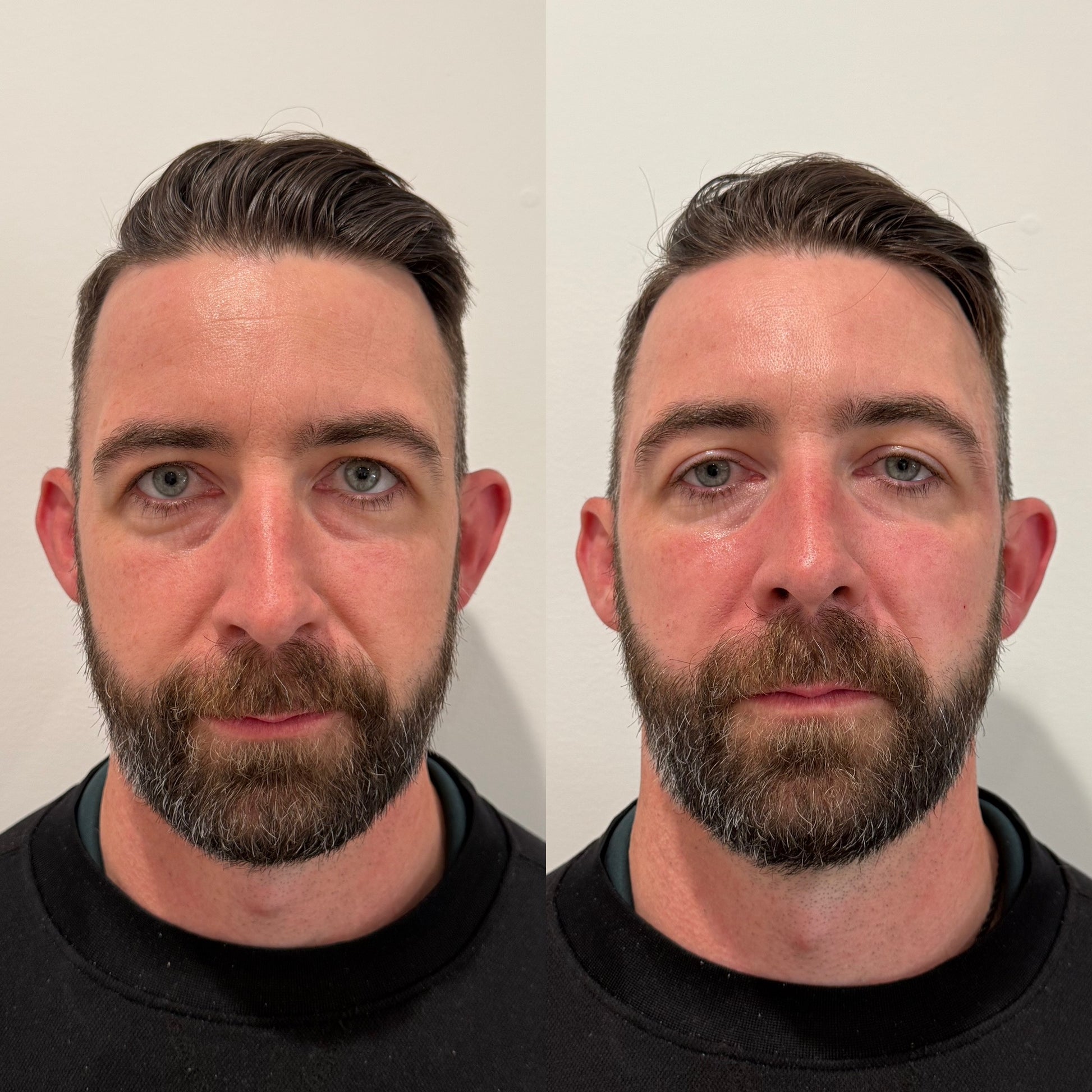 LUV U: Mini Luxe. Lift Package + FREE 20 Units Botox