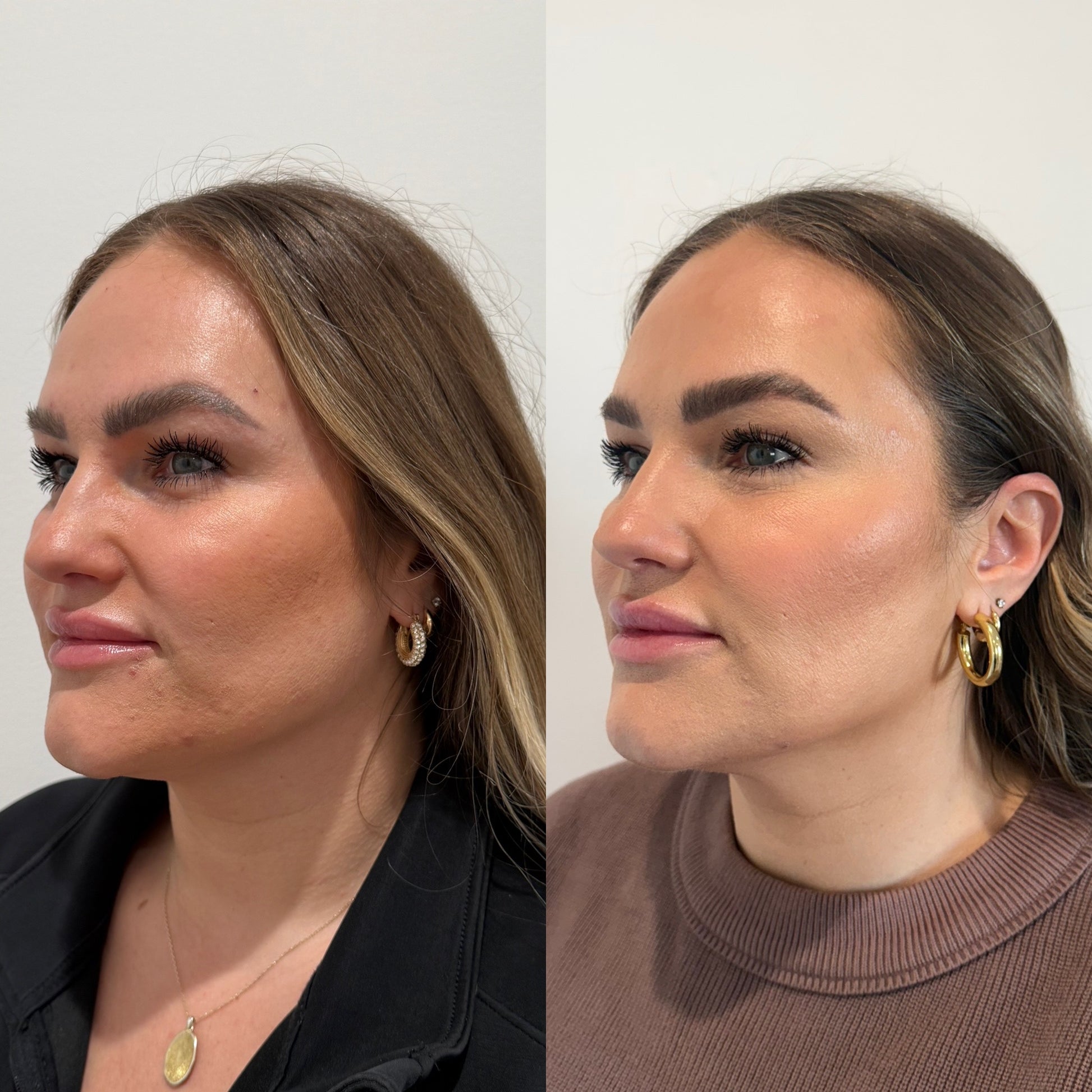 LUV U: Luxe Lift Package + FREE 40 Units Botox