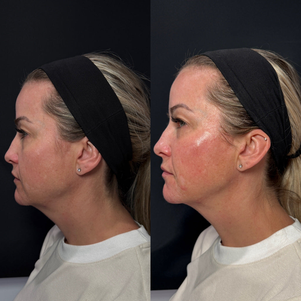 LUV U: Deluxe Lift Package + FREE 60 Units Botox