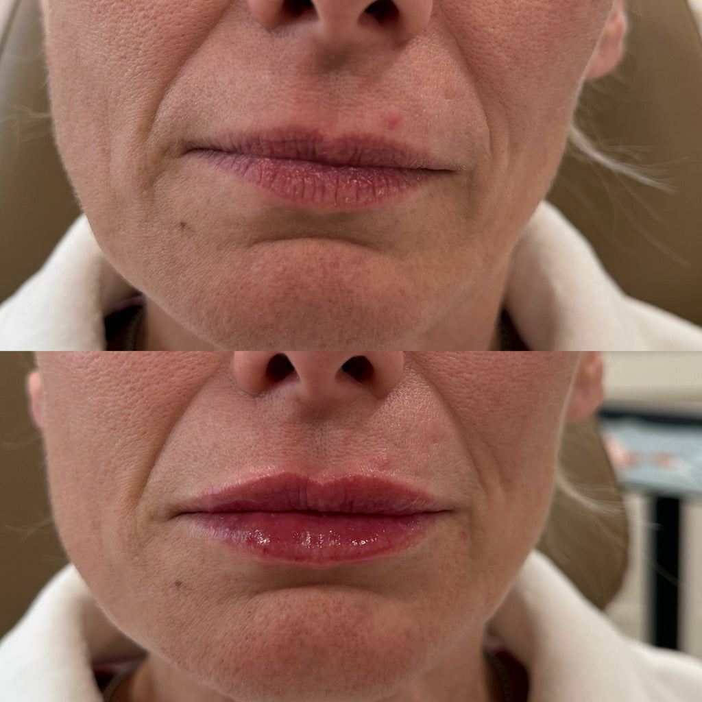 LUV U: Cherry Kiss + FREE 20 Units Botox