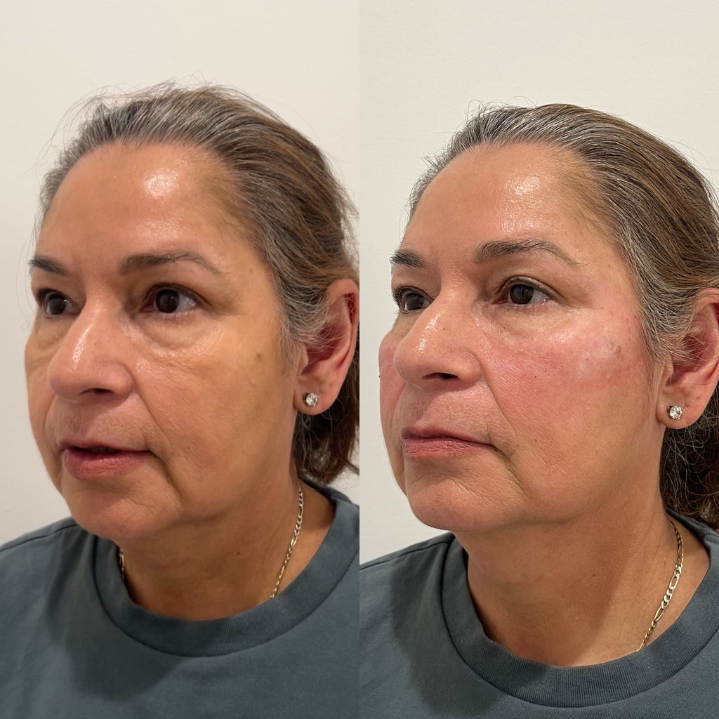 LUV U: Deluxe Lift Package + FREE 60 Units Botox