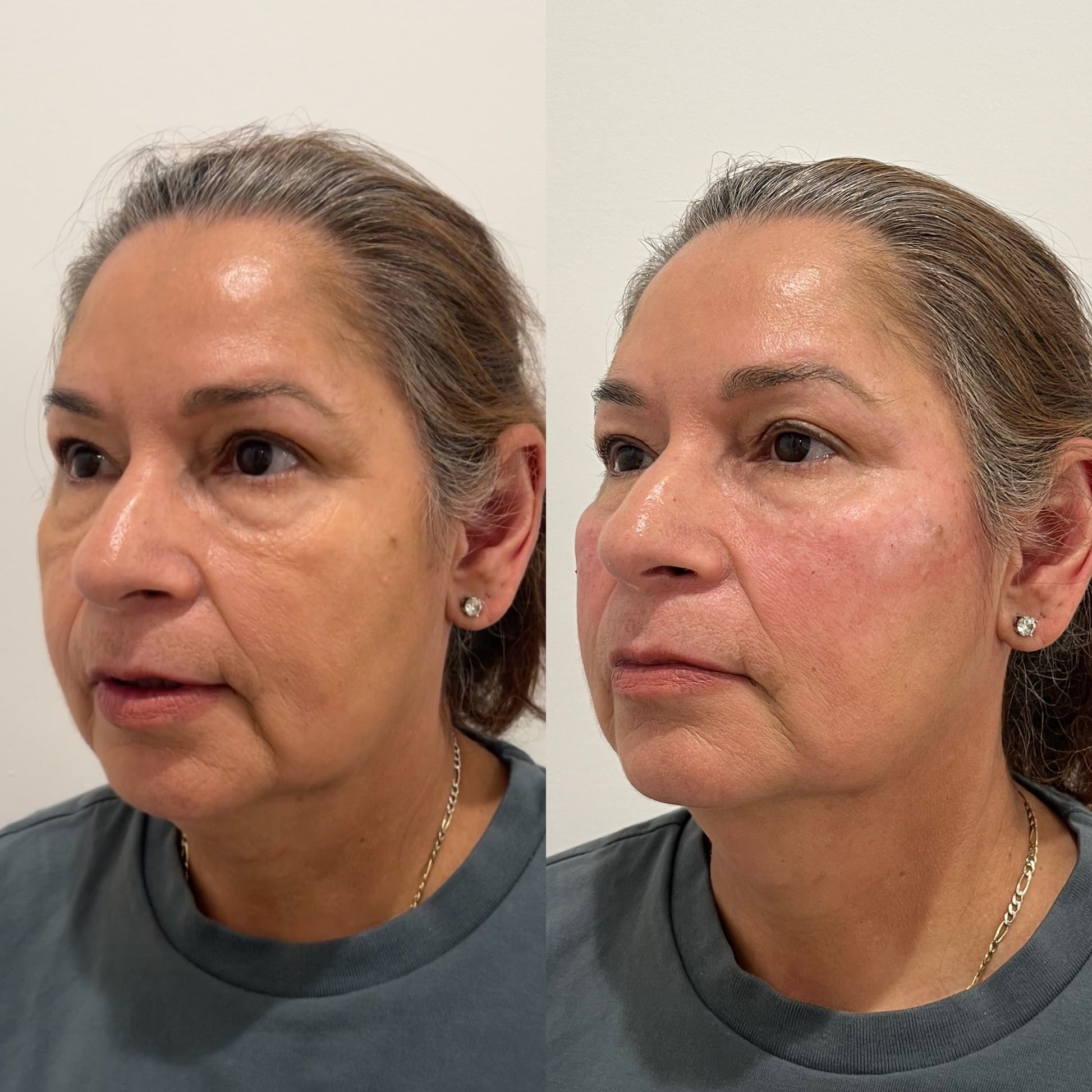 LUV U: Deluxe Lift Package + FREE 60 Units Botox