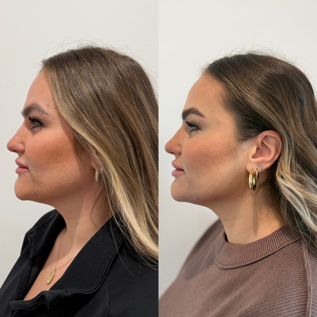 LUV U: Luxe Lift Package + FREE 40 Units Botox