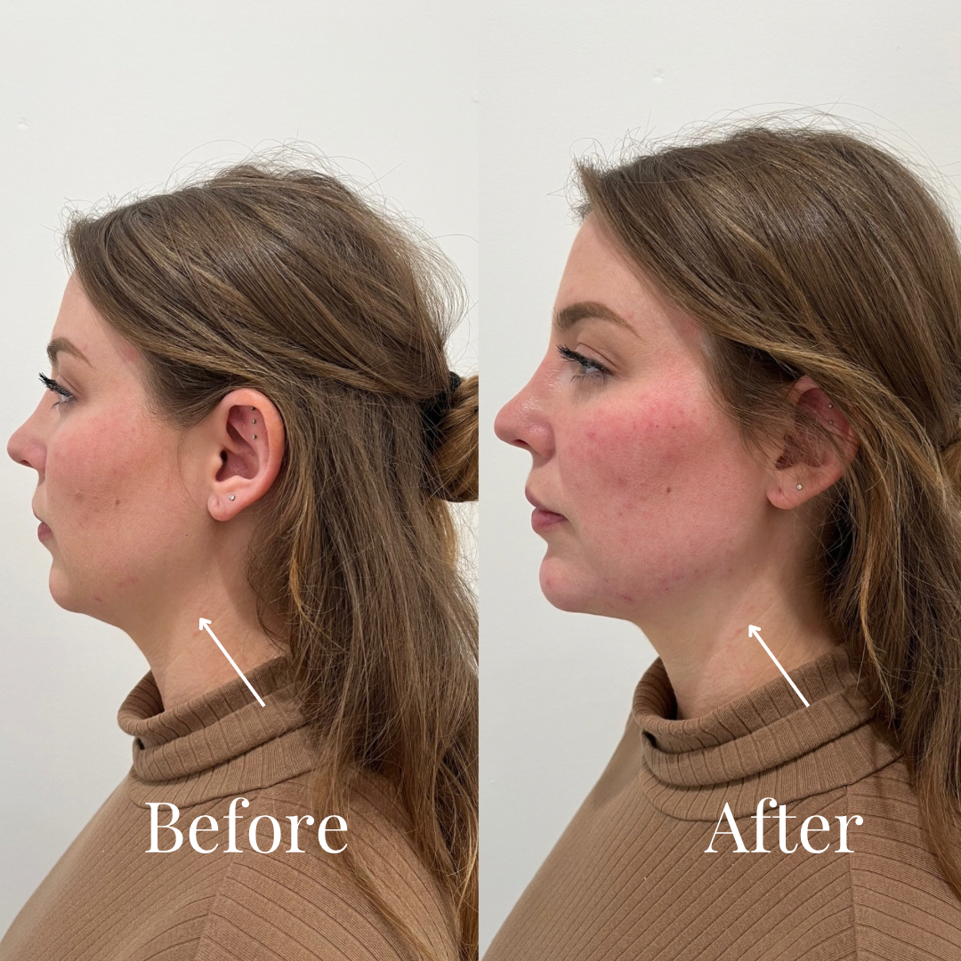 LUV U: Deluxe Lift Package + FREE 60 Units Botox