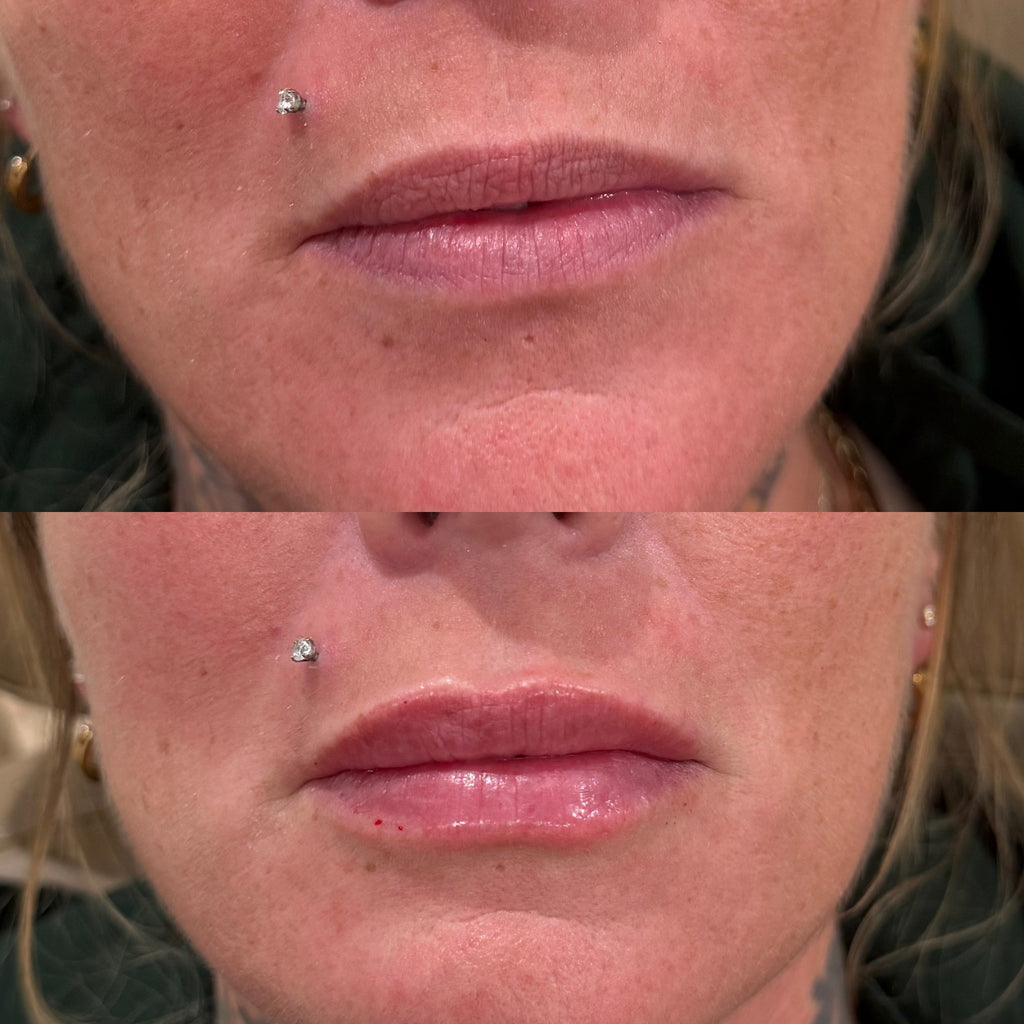 LUV U: Cherry Kiss + FREE 20 Units Botox