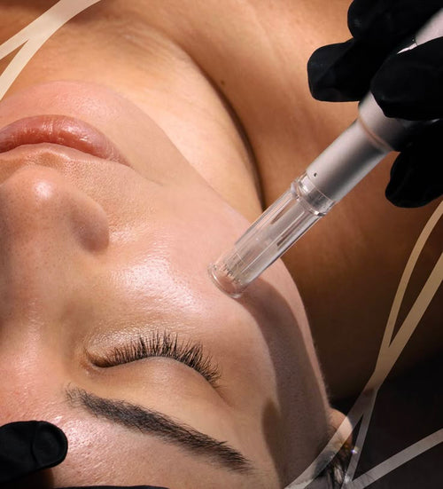 Deluxe Microneedling (Micro + Exosomes)